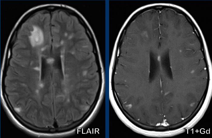 Mutiple Sclerosis