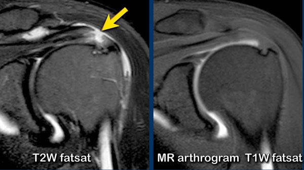 Rách mặt túi hoạt dịch không quan sát thấy trên MRI khớp có thuốc tương phản từ.