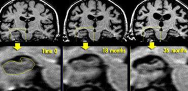 Coronal T1WI of the hippocampus demonstrating progressive atrophy in familial AD (images kindly provided by Nick Fox).