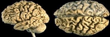 Specimen in end stage AD demonstrating severe global atrophy. Courtesy Webpath (11).