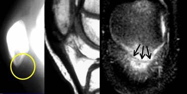 Bong gân bánh chè dạng vỏ bọc (Patellar sleeve avulsion). Đường gãy chỉ nhìn thấy trên ảnh mặt phẳng đứng ngang (coronal).