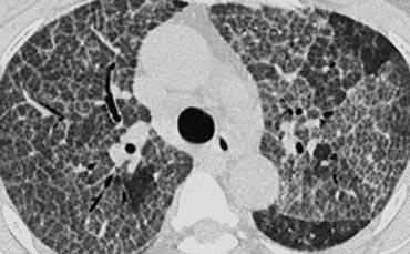 Crazy Pavin in a patient with Alveolar proteinosis.