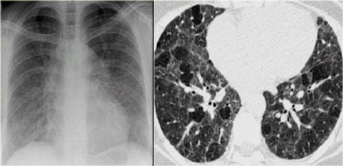 Viêm phổi quá mẫn mạn tính: Phim ngực không đặc hiệu, hình ảnh HRCT điển hình.
