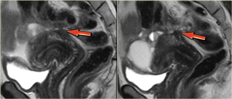 Lạc nội mạc tử cung xâm lấn torus uterinus