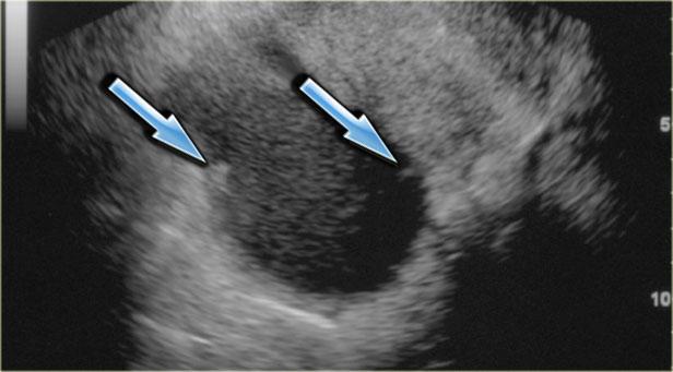 Siêu âm qua đường âm đạo: endometrioma với hai ổ tăng âm ở thành, phù hợp với lắng đọng cholesterol (mũi tên)