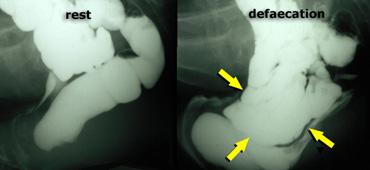 Normal findings at rest (left); during defecation there is a rectocele, that is pushed downward by an enterocele .