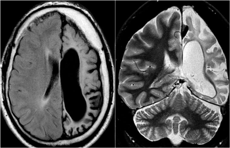 Viêm não Rasmussen. Ảnh FLAIR axial và T2WI coronal cho thấy teo bán cầu đại não trái kèm giãn não thất bên.
