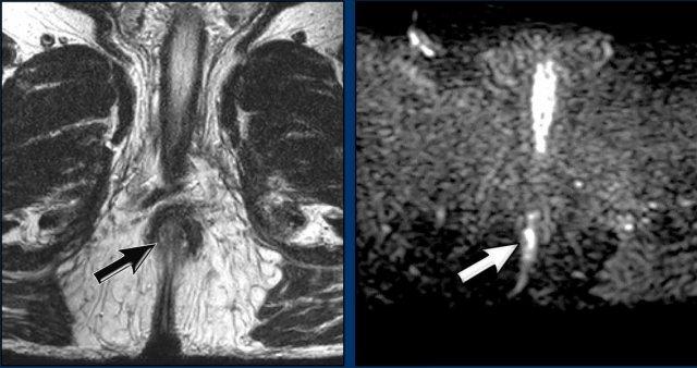 Khối u còn sót lại 6 tuần sau hóa xạ trị.