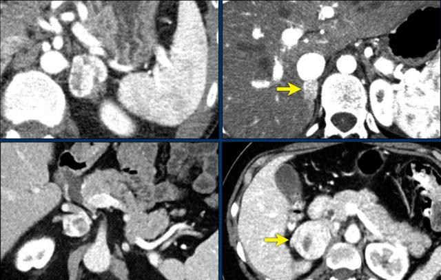 Pheochromocytomas. All show strong enhancement, even in the smaller tumors. These cases were diagnosed by biochemical testing.