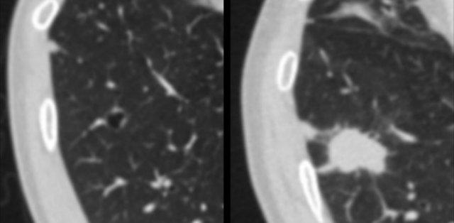 Cystic lung cancer demonstrating 'solidification'