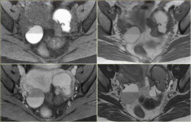 Endometrioma