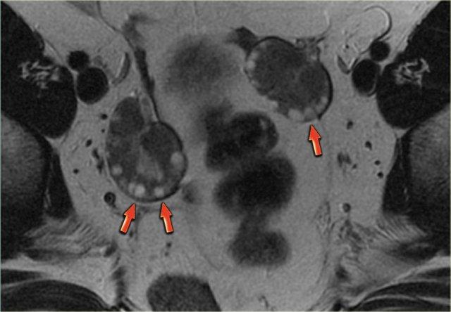Hình MRI mặt cắt ngang cho thấy hình ảnh đặc trưng 'chuỗi hạt ngọc trai'